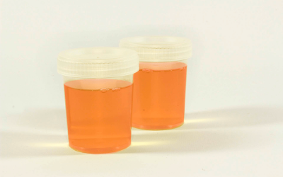 La sangre en la orina,  es motivo para consultar a la brevedad posible